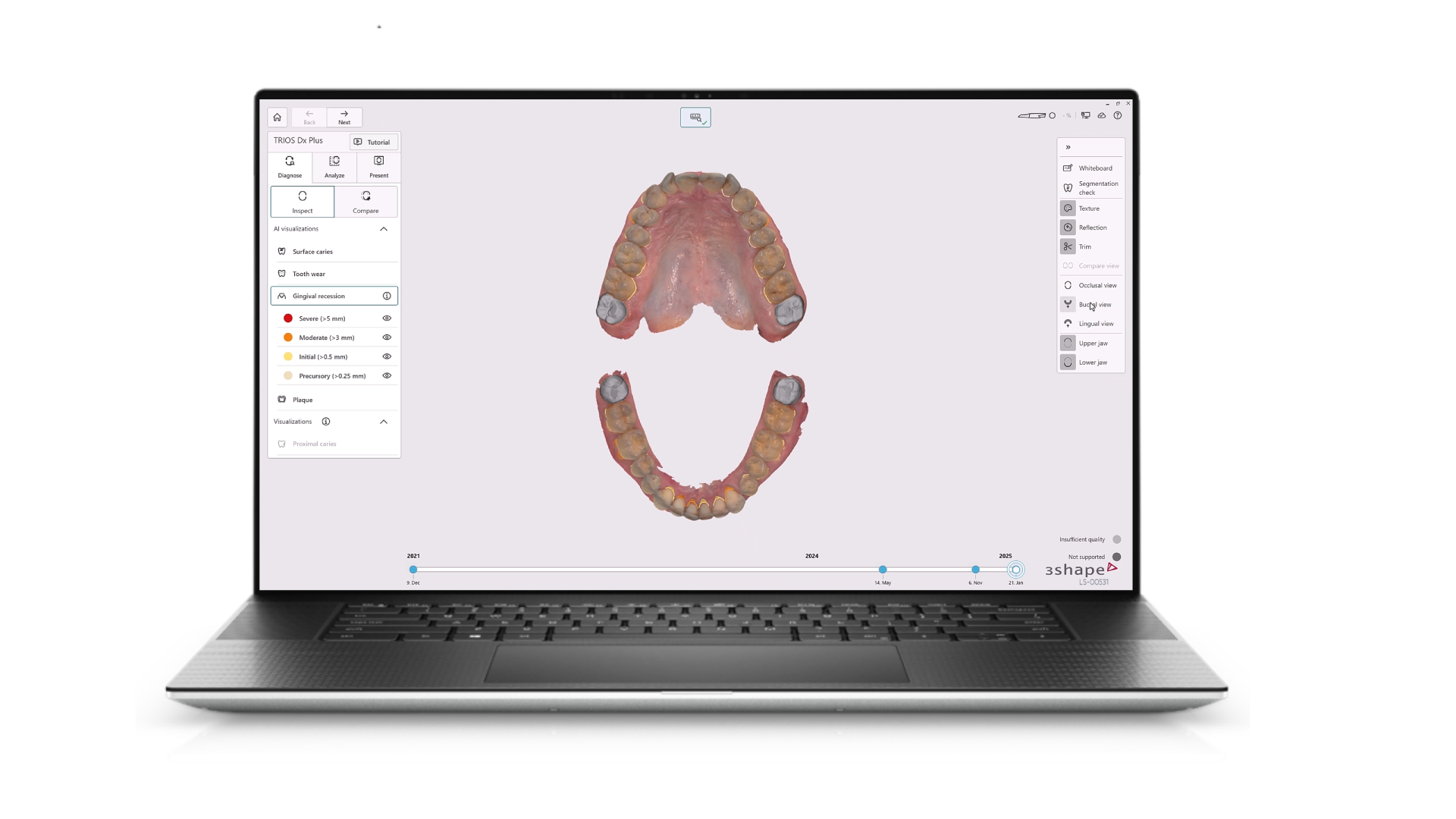 Detailed dental model on laptop