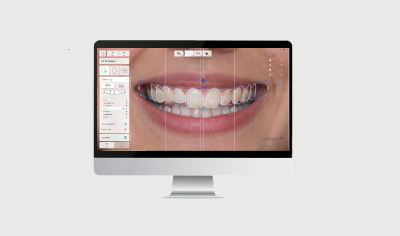 TRIOS Smile Design